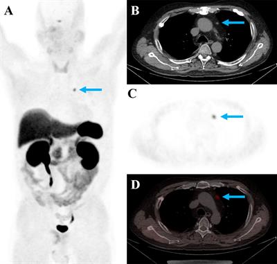 Site-specific performance of 68Ga-DOTATATE PET/CT in detecting tumors with ectopic adrenocorticotropic hormone secretion